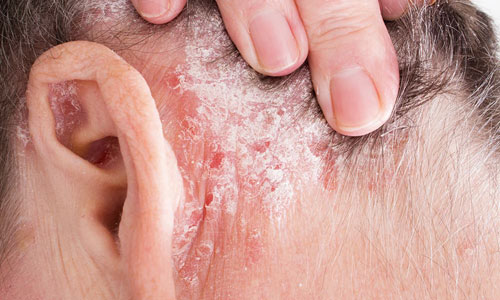 Шелушится кожа на лице: причины и лечение шелушений, появление сухости и симптомы заболеваний